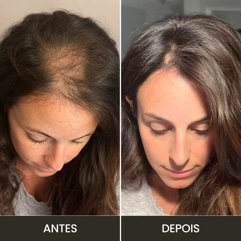 Derma Capilar™: Aparelho de Alta Frequência Profissional para Tratamento Capilar e Facial com 4 Eletrodos