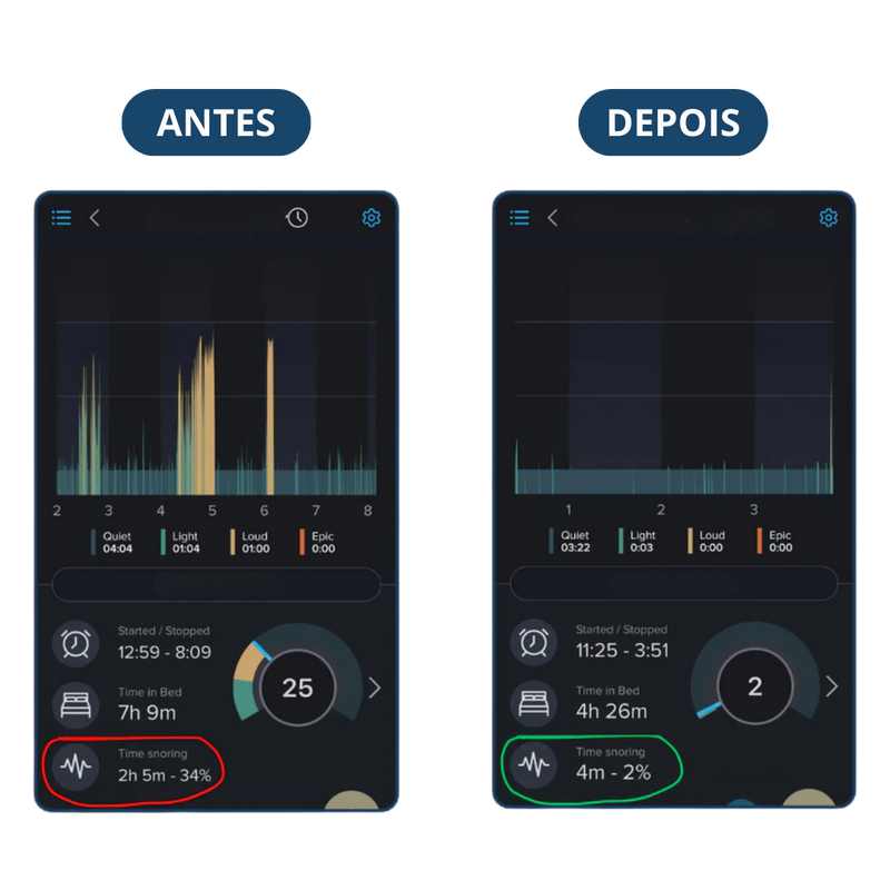 Protetor Bucal Anti-Ronco Znorex®