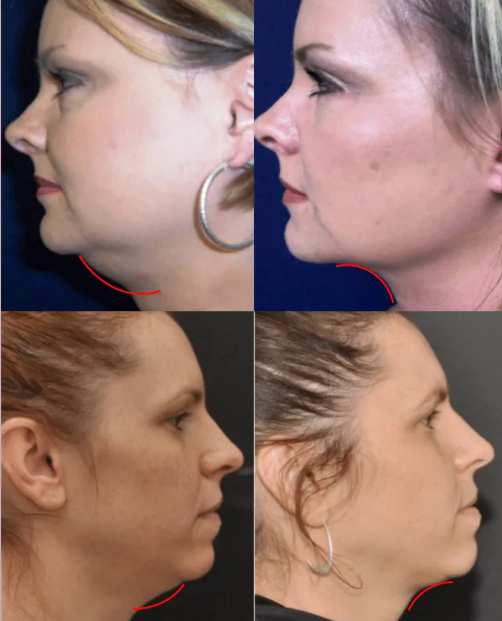 V-Revitalize™ - Máscara de Contorno Facial - Suaviza Rugas, Papada e Modela o Rosto