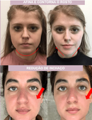 V-Revitalize™ - Máscara de Contorno Facial - Suaviza Rugas, Papada e Modela o Rosto